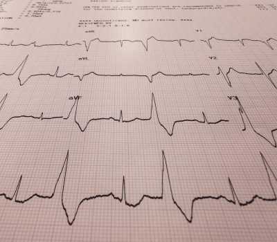 The,Photograph,Shows,An,Electrocardiogram,Of,Bigeminy,Pvc,With,St